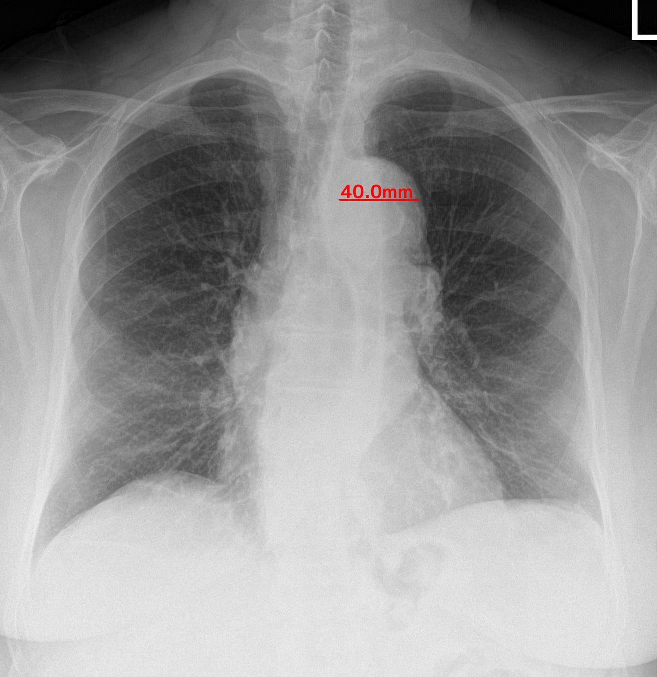 胸部x線画像の読影診断を支援するeirl Chest Screening 肺結節候補域の検出と5つの計測機能を有する新モデルとして販売開始 Lpixelのプレスリリース 胸部x線画像の読影診断を支援するeirl Chest Screening 肺結節候補域の検出と5つの計測機能を有する新モデルとして販売開始 Lpixelのプレスリリース