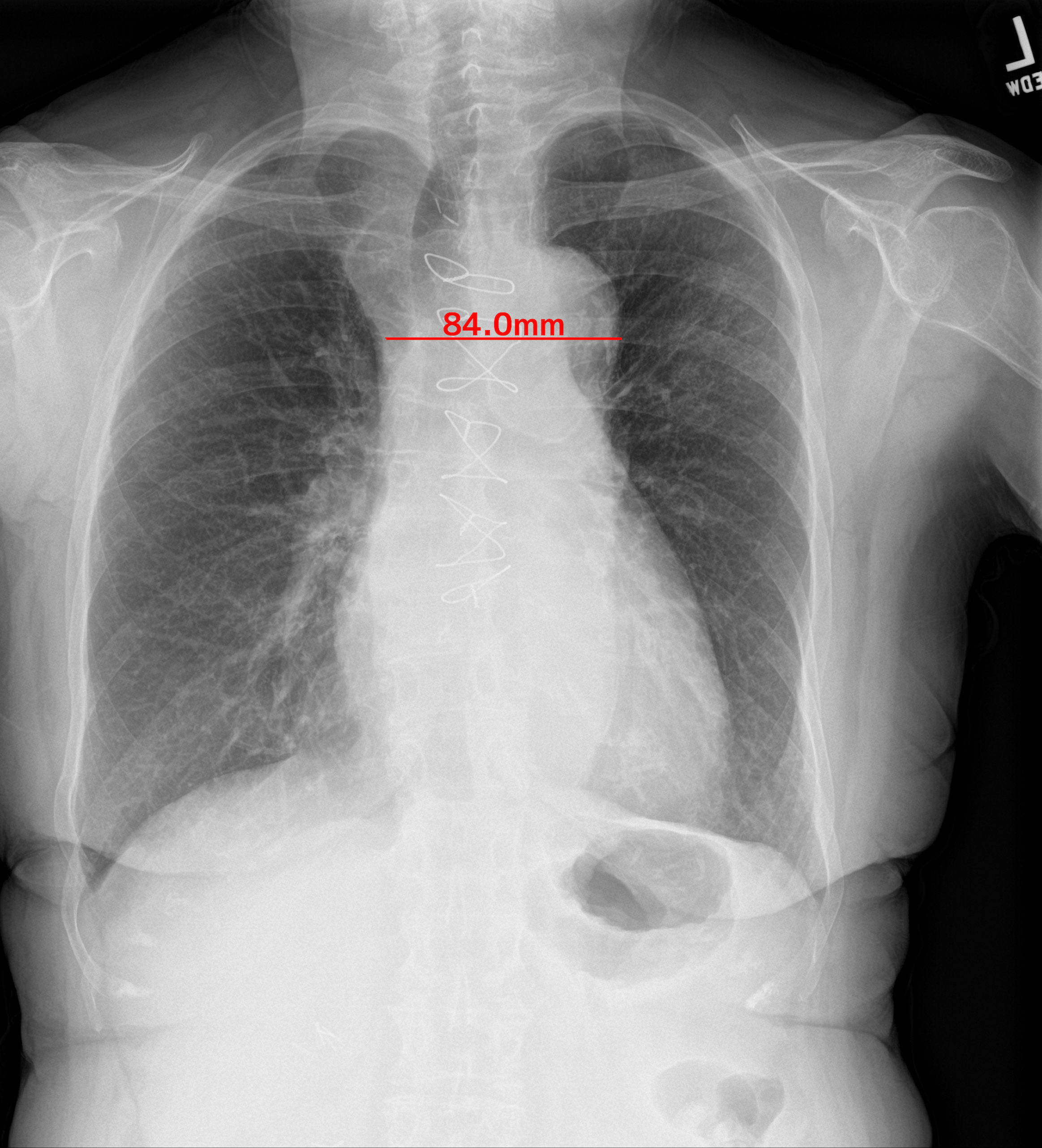 胸部X線画像の読影診断を支援するEIRL Chest Screening、肺結節