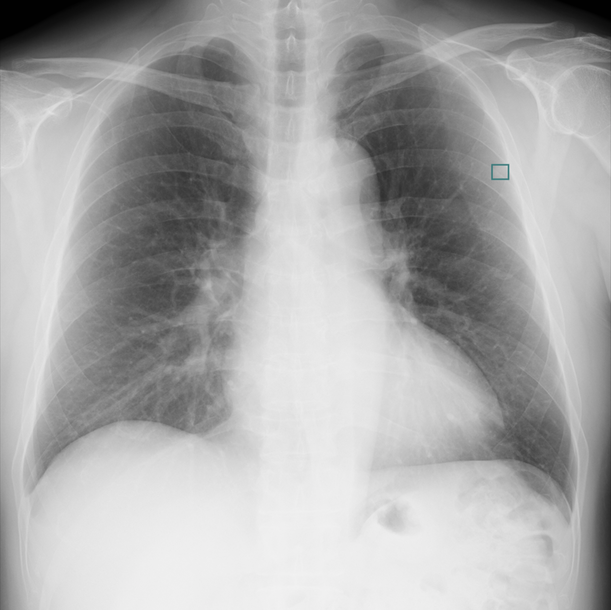 EIRLによる肺結節候補域検出例