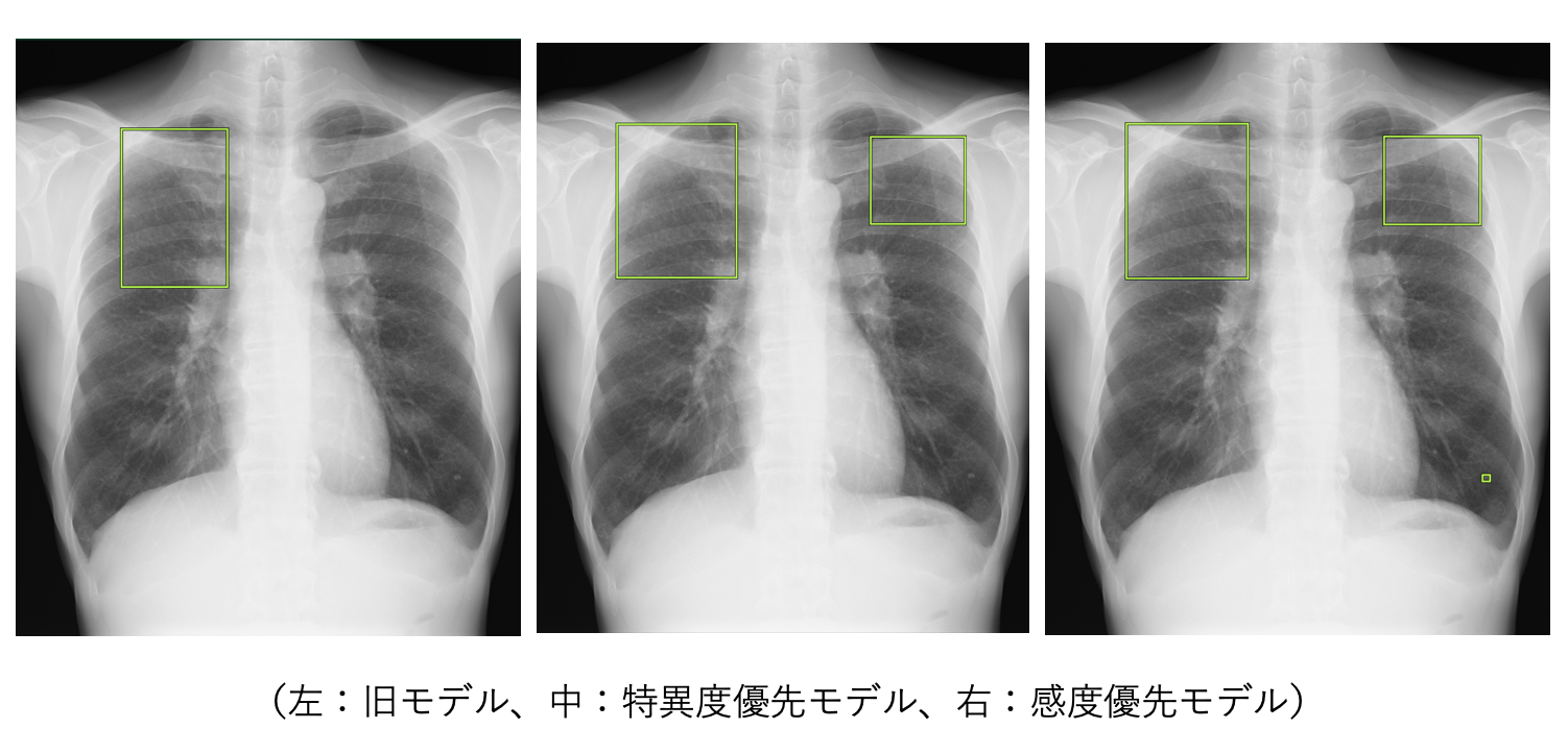 胸部X線画像の読影診断を支援するEIRL Chest Screening、感度優先