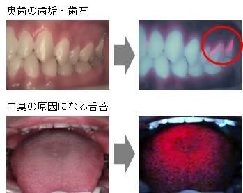 光を当てるだけの新しい歯垢の可視化方法 QLFライト | 歯っぴー株式会社のプレスリリース
