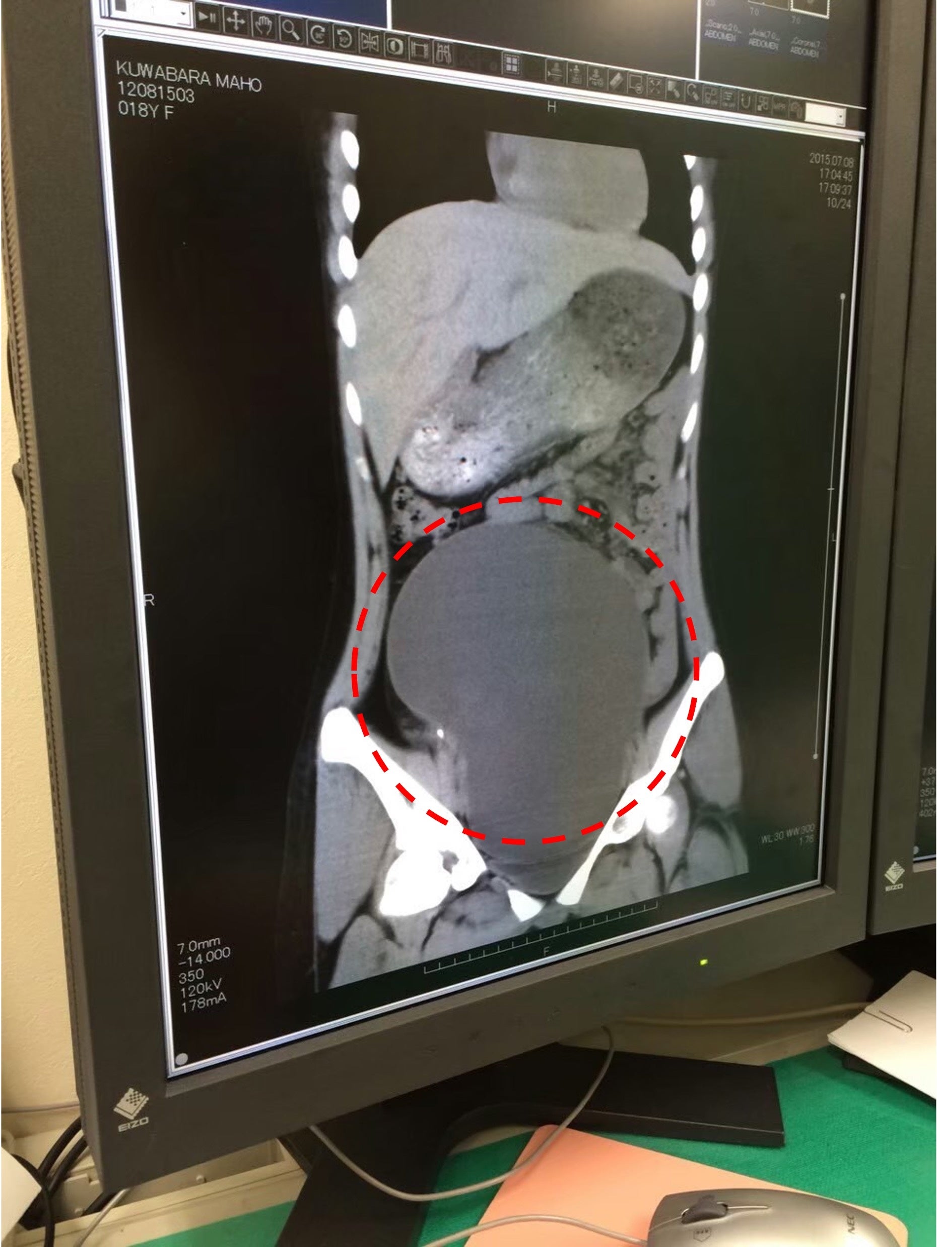 18歳の時に摘出した30センチの腫瘍