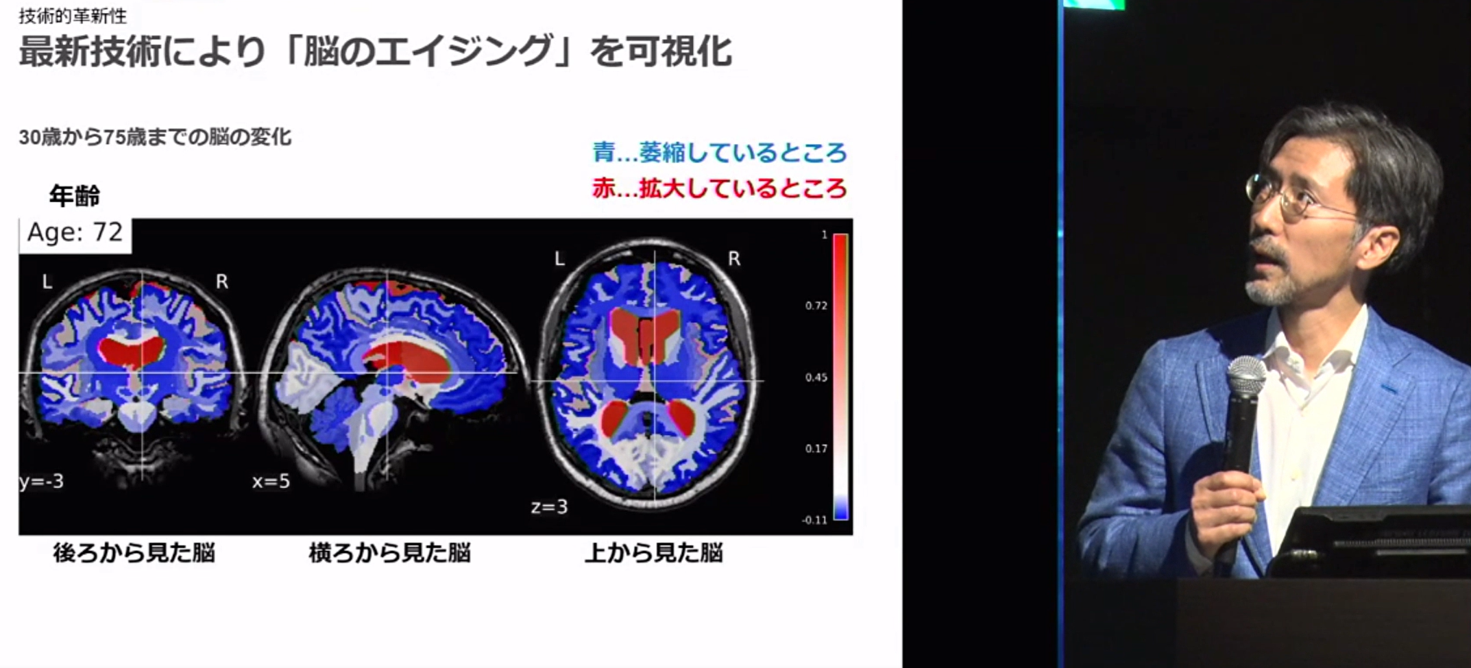 脳の加齢性変化を可視化するMVision