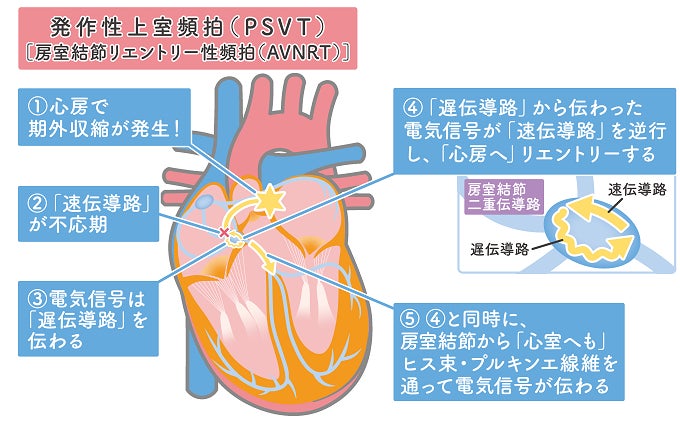 大きなイラストを用い、患者さんの心臓で何が起こっているのかを解説