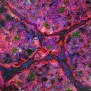 Fig. 1. TNBC89バイオマーカー(赤) が、エストロゲン受容体(緑)の発現が低い浸潤性乳管癌を染めている。