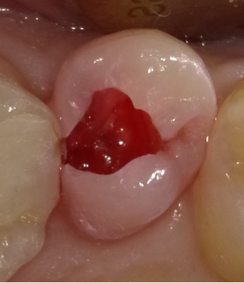 かくれ虫歯の表面を削った後