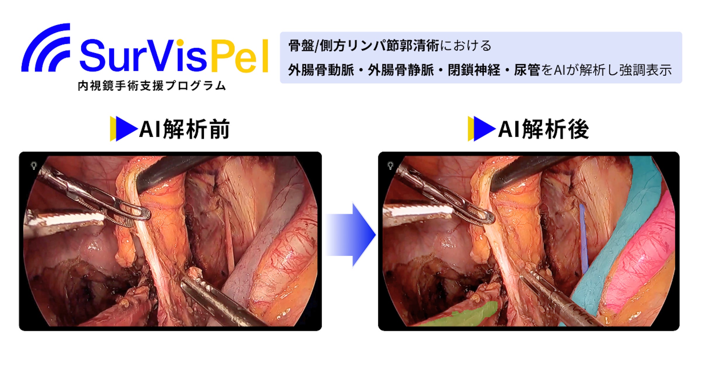 Jmeesと国立がん研究センター東病院が共同開発した「内視鏡手術支援 Jmeesと国立がん研究センター東病院が共同開発した「内視鏡手術支援