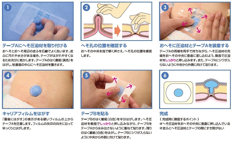 乳児の臍 さい ヘルニア圧迫療法に へそ圧迫材パック リニューアル発売 ニチバン株式会社のプレスリリース 乳児の臍 さい ヘルニア圧迫療法に へそ圧迫材パック リニューアル発売 ニチバン株式会社のプレスリリース