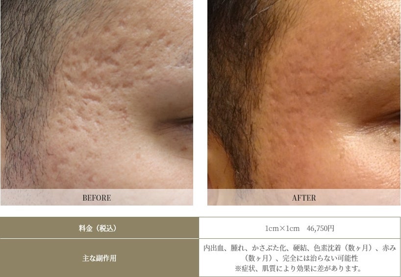 他にニキビ跡に効くものは何でしょうか?