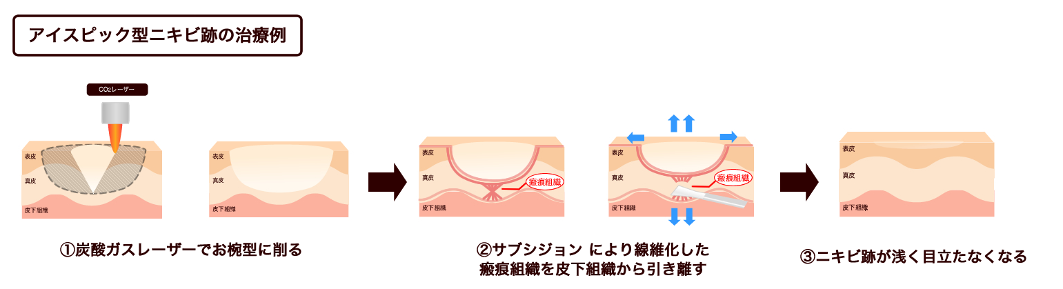 アイスピック型ニキビ跡の治療例