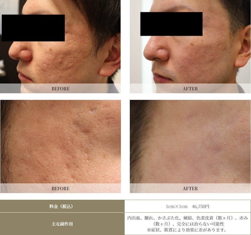 ローリング＋ボックス型の深いニキビ跡を花房式（サブシジョン＋炭酸ガスレーザー）で３回治療後、２ヶ月後の症例写真です。かなり平坦化しているのがおわかりいただけるかと思います。