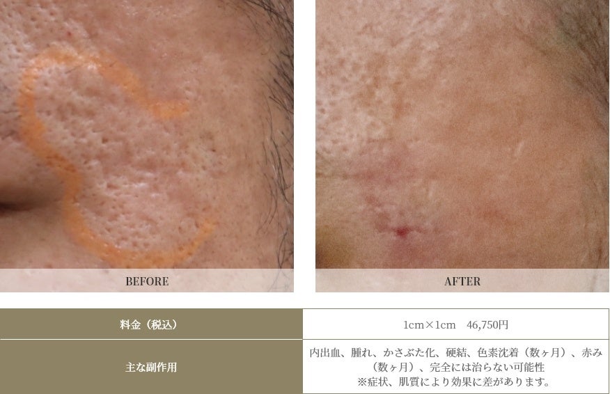 ローリング＋ボックス型の深いニキビ跡。花房式ニキビ跡治療１回施術、１ヶ月後