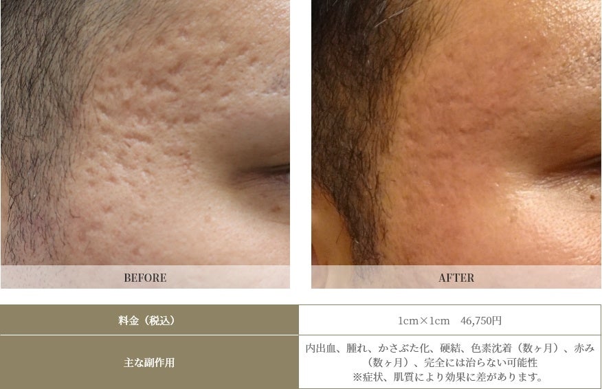 ボックス型の深いニキビ跡。花房式ニキビ跡治療４回施術、１ヶ月後 