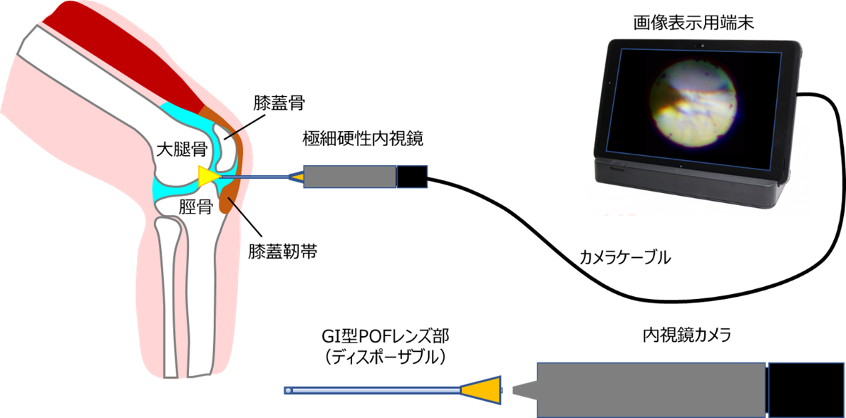 図3　極細硬性内視鏡による膝関節内検査イメージ