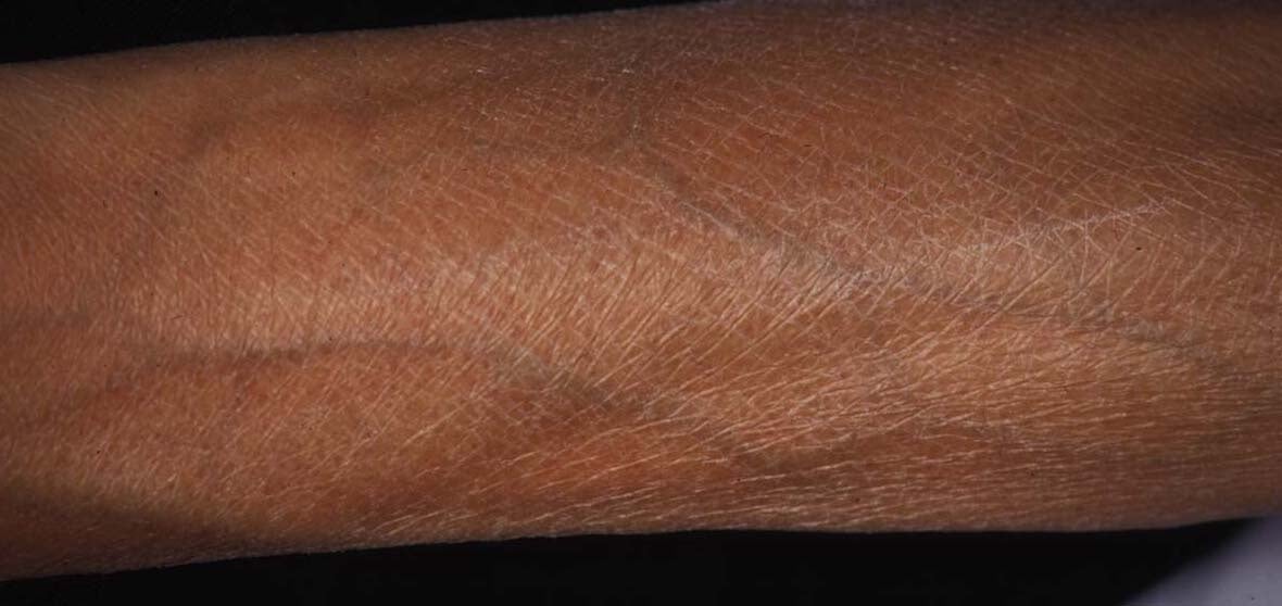 ドライスキン状態の皮膚　提供：宮地 良樹先生