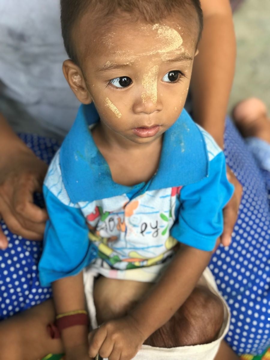 臍帯ヘルニアという先天性の異常により内臓がお腹の外に飛び出してしまっている一歳の男児患者