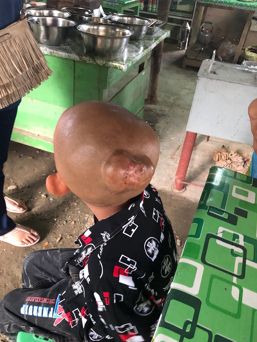 頭部腫瘍をもつ患者の術前