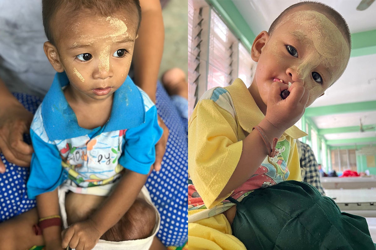 臍帯ヘルニアという先天性の異常により内臓がお腹の外に飛び出してしまっている小児患者の7月初診時（左）と現在（右）。治療継続中で経過良好。来年カンボジア拠点病院にて手術予定