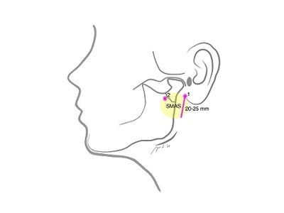 耳垂直下のアプローチ