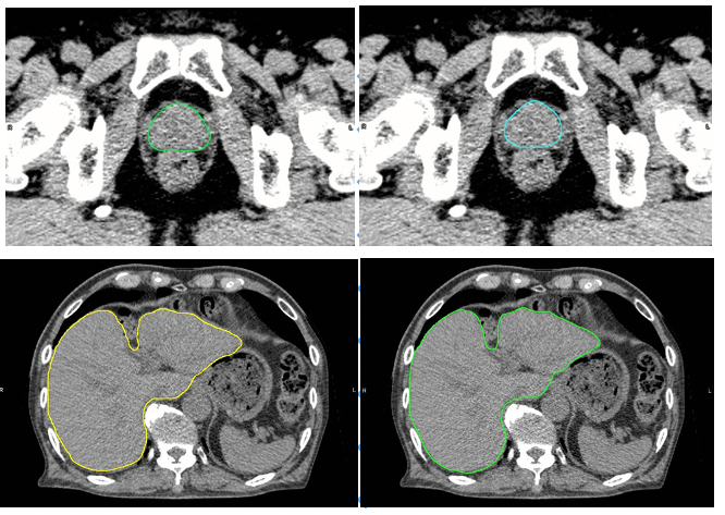 図の上は前立腺、下は肝臓のCT画像。左はAi-Segによる自動抽出、右は医療従事者の手入力による抽出。Ai-Segによる描画は医療従事者による描画と遜色ない精度で輪郭を自動作成が可能（図の提供：大阪大学プレスリリースより※）
