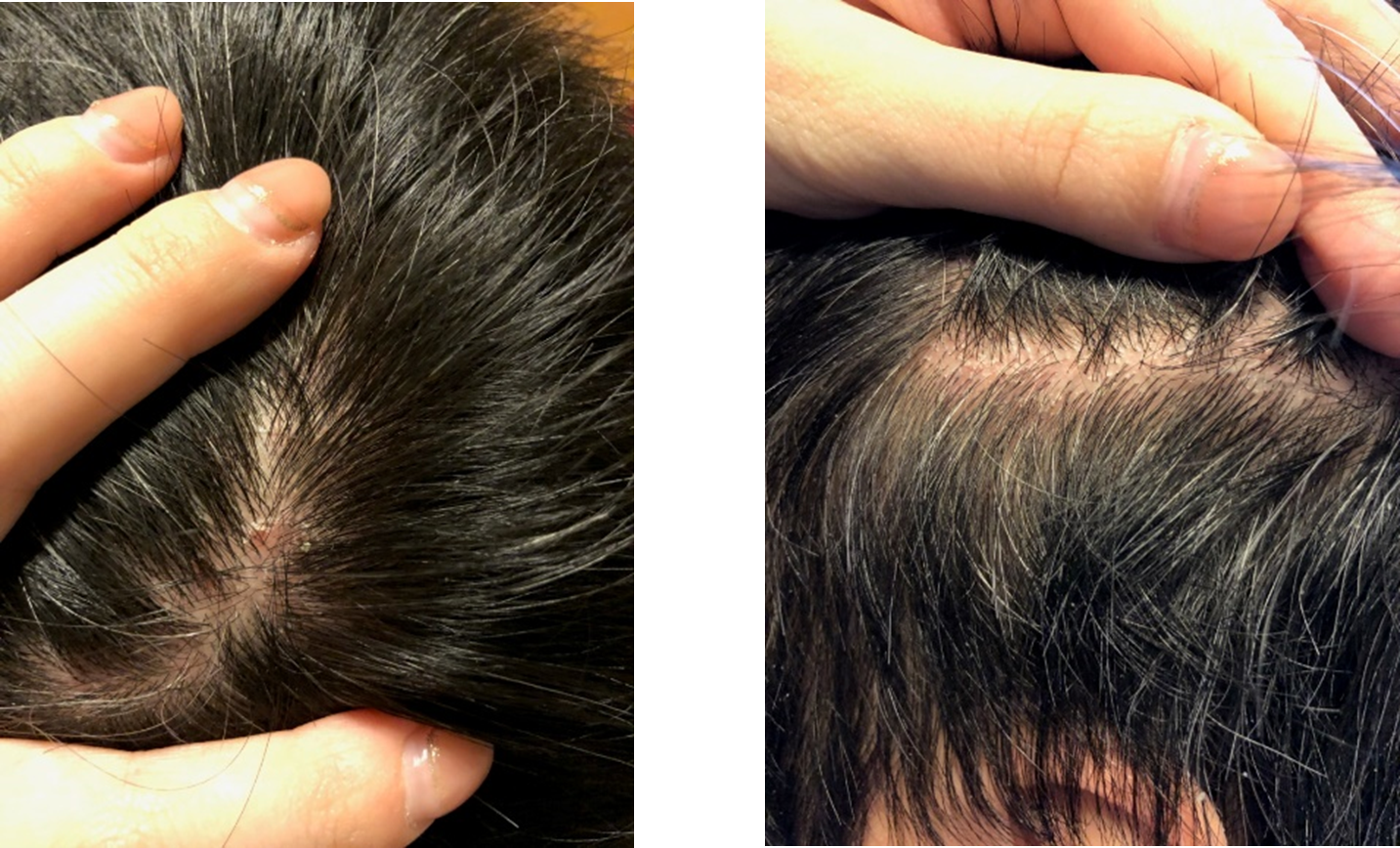 花粉により頭皮が炎症した症例(クレアージュ東京エイジングケアクリニック提供)