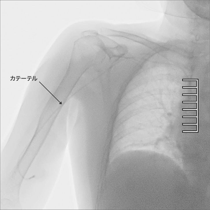 通常では見ることが難しかった部分のカテーテルも鮮明に観察可能