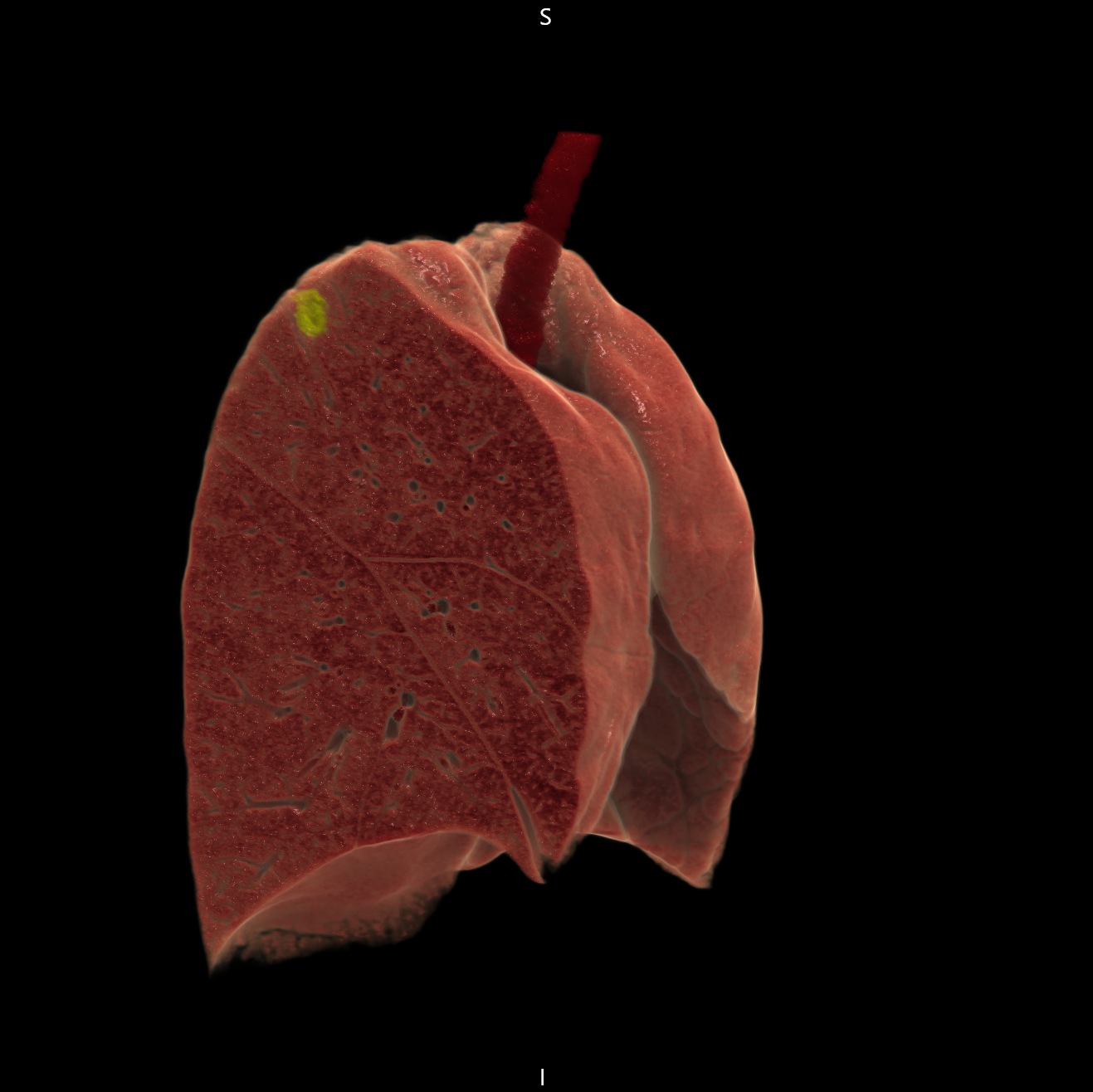 c 全肺野３Ｄ画像（黄色部が病変）