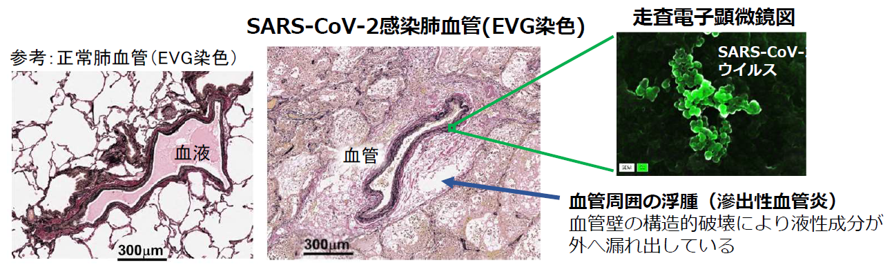 図1. COVID-19患者肺の病理学的解析