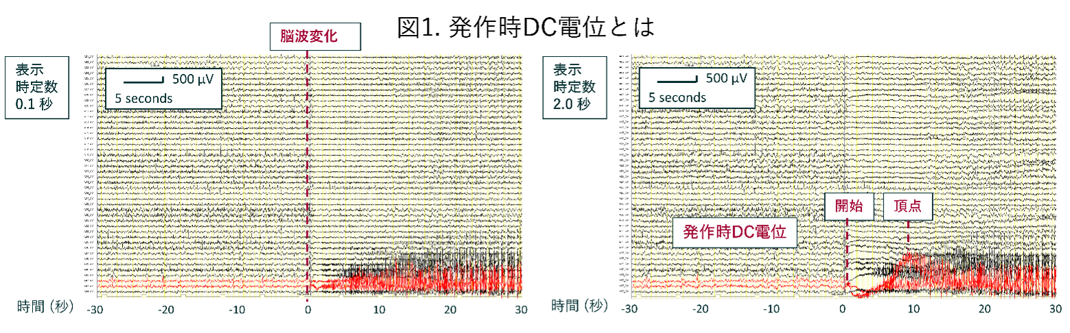 難治てんかん焦点の新しいバイオマーカー「発作時DC電位」 世界で