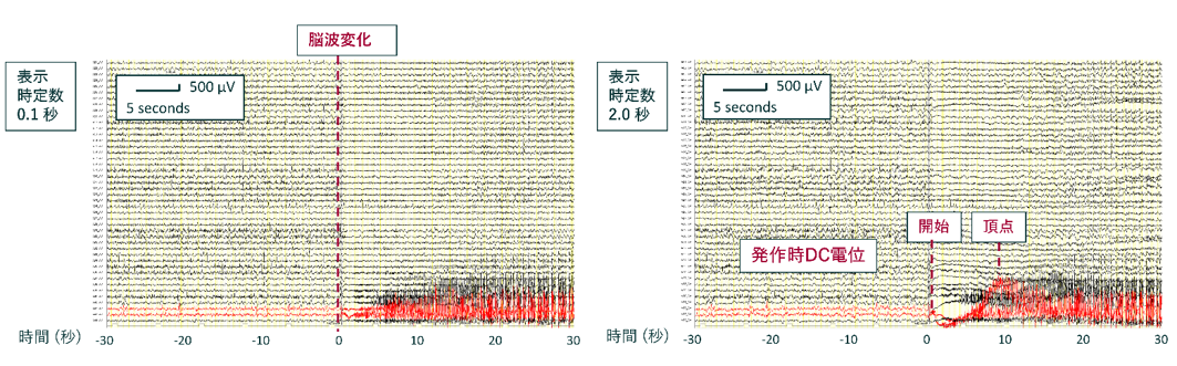 【 稀少 】てんかん発作時脳波アトラス 1987年発行 稀少 】てんかん発作時脳波アトラス 1987年発行 本