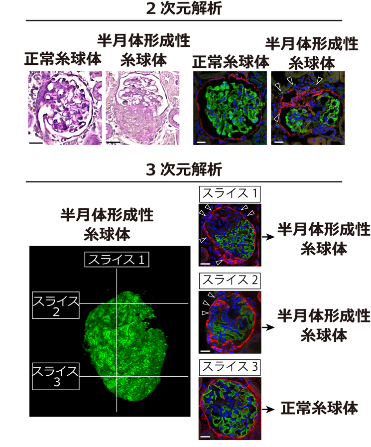 腎臓を透明にして3次元で糸球体の異常を診断 ―組織透明化技術で正確に
