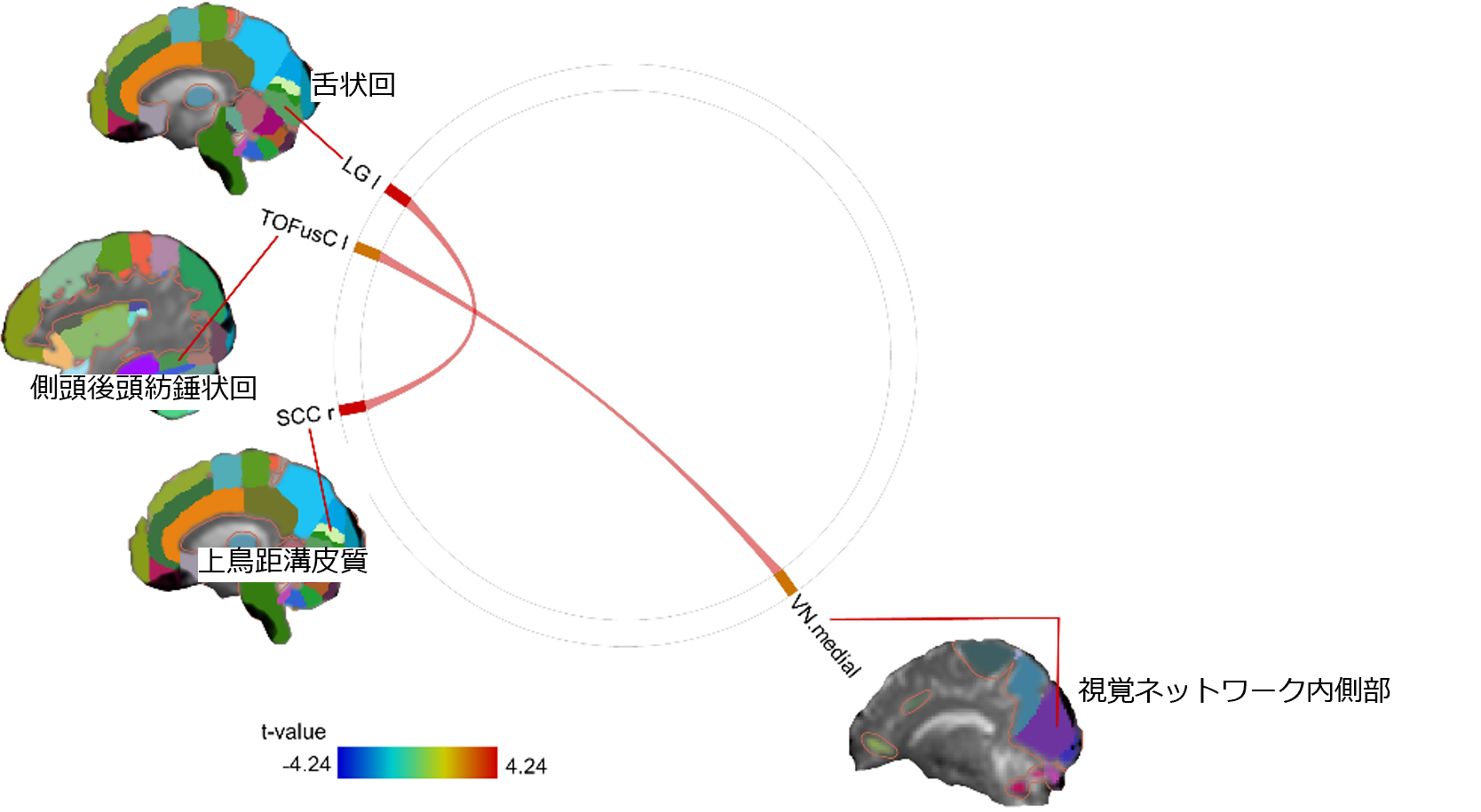 神経性やせ症（拒食症）の脳機能異常を網羅的に解明 ～世界初 多