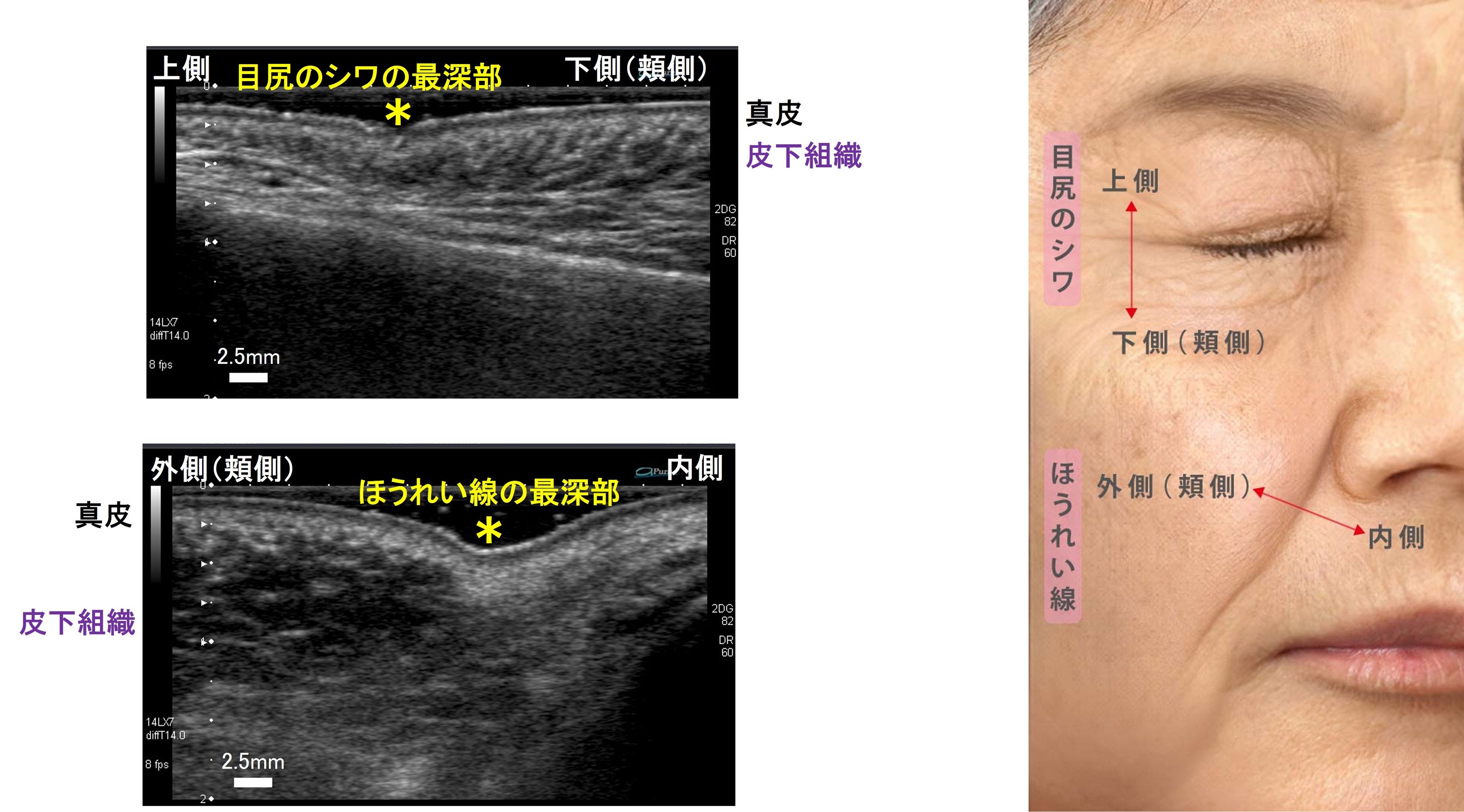 花王生物科学研究所 調べ (画像上：目尻のシワ部位 画像下：ほうれい線部位) (70代女性)実画像を元に作成したＣＧイメージ