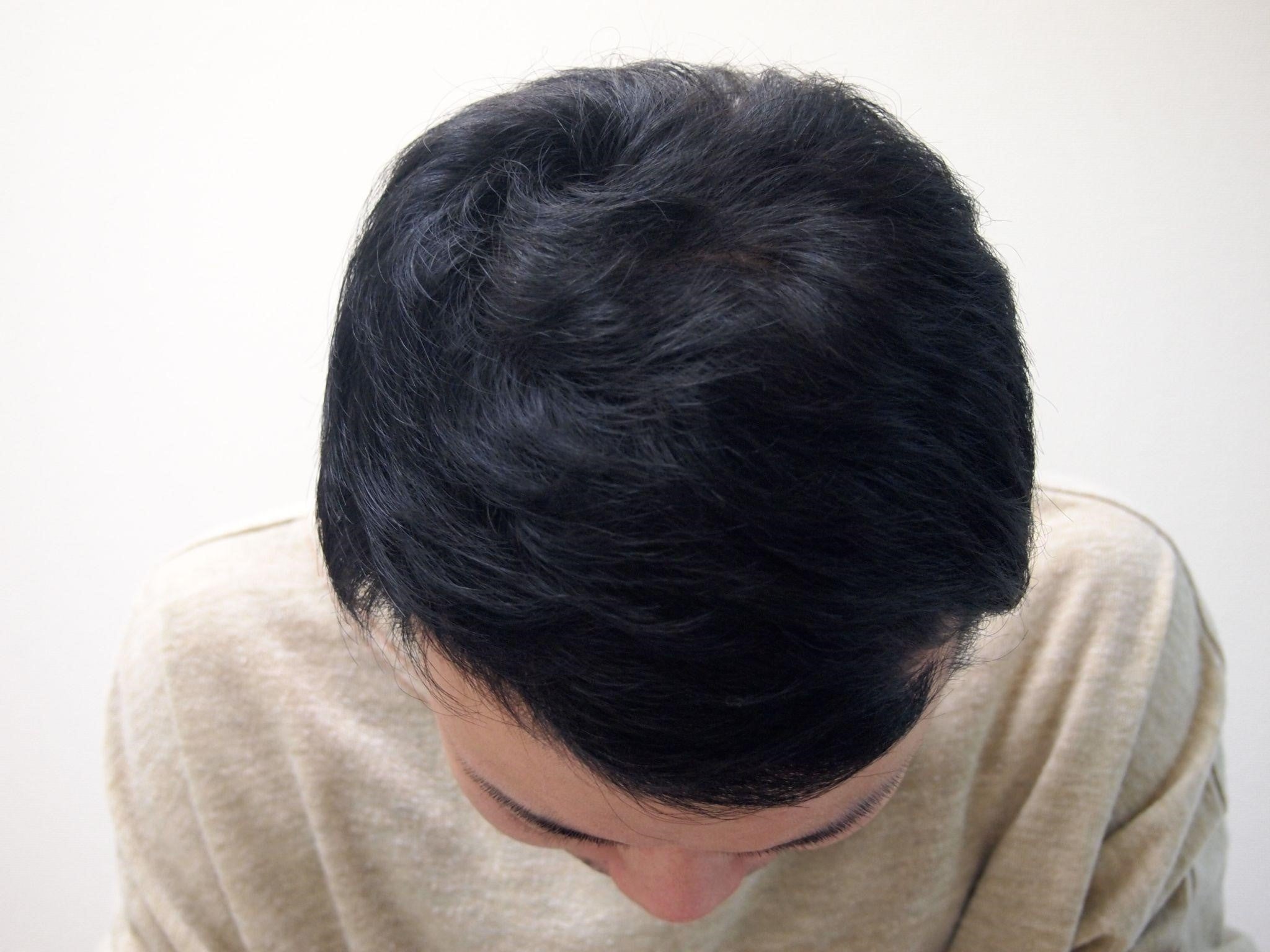 AGA治療６か月後