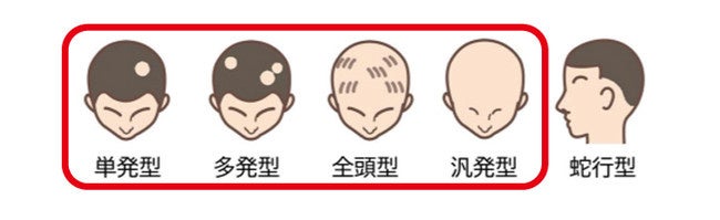 円形脱毛症の種類