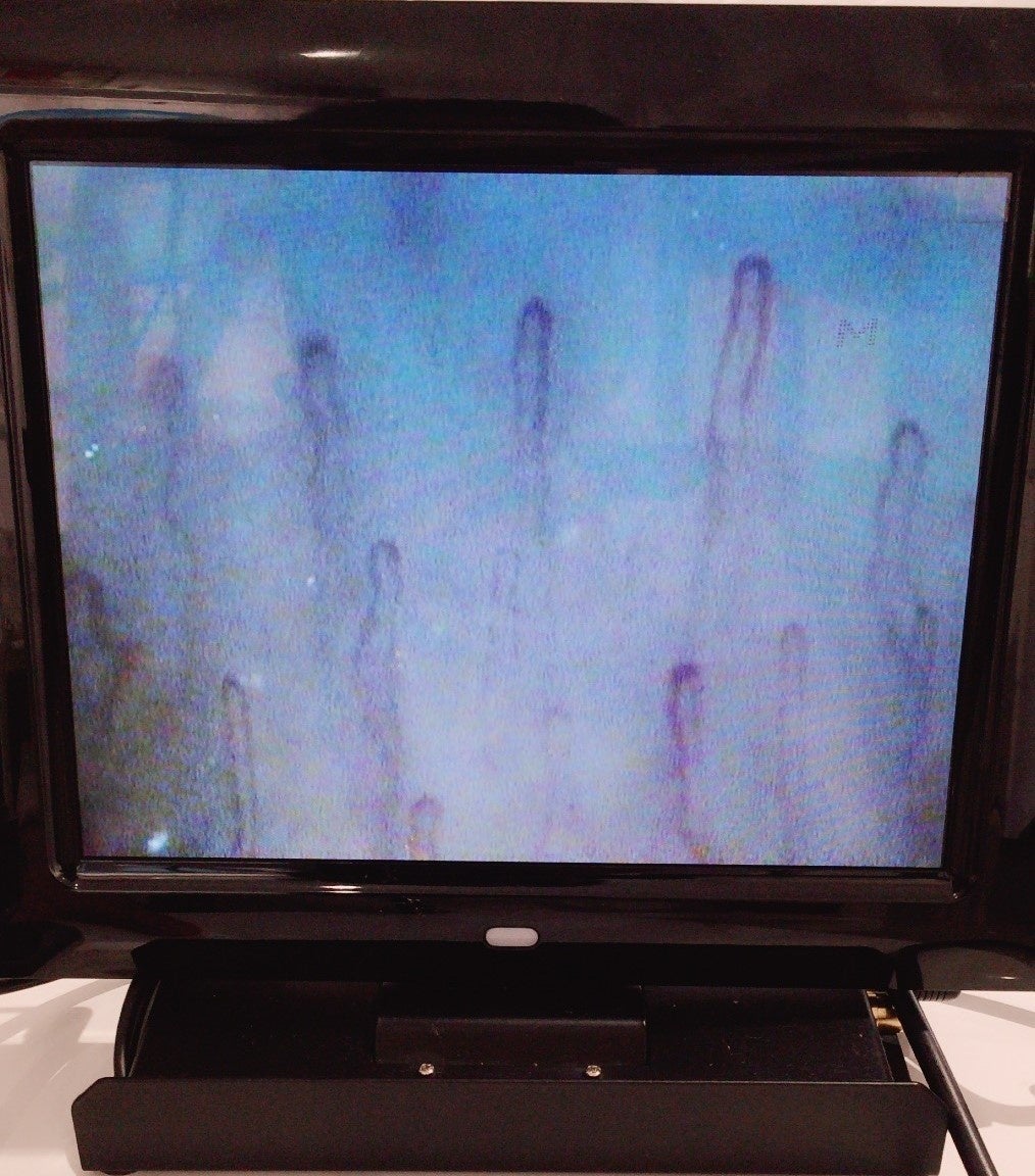 毛細血管測定結果イメージ