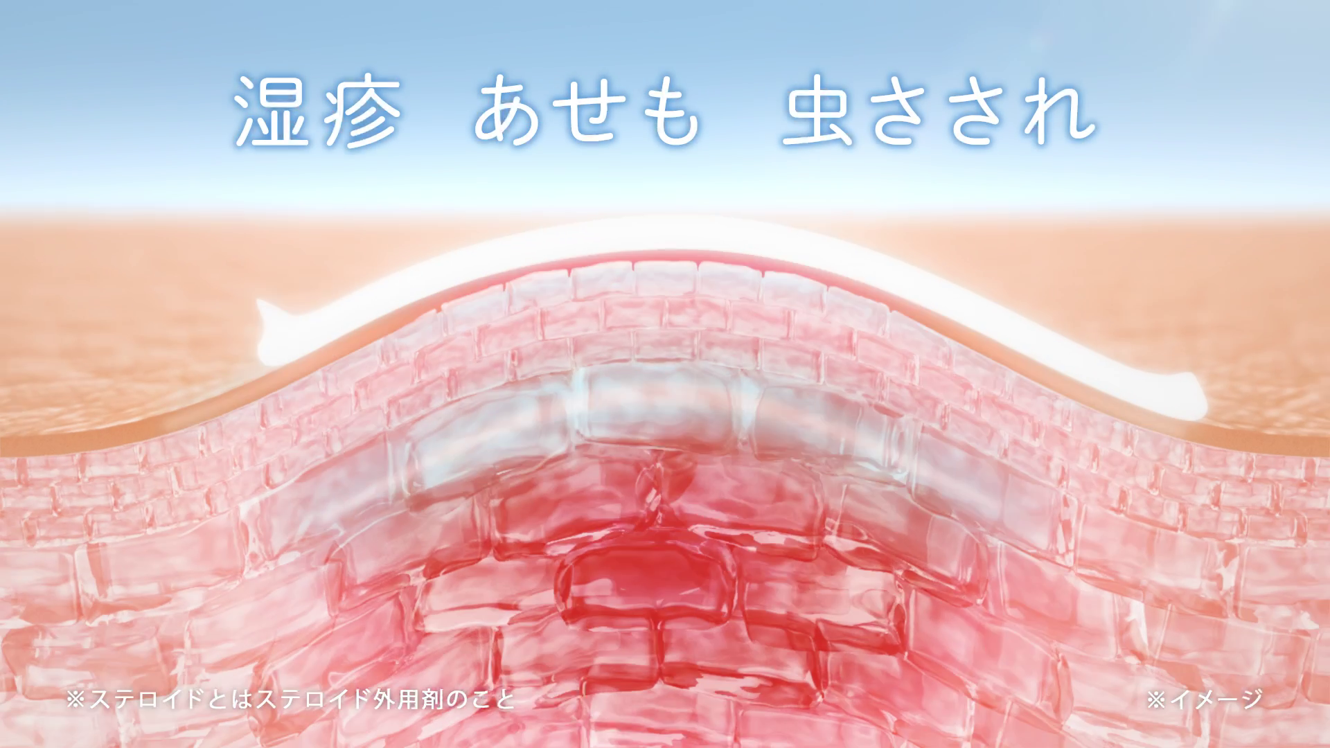 「ステロイドの力で、イッキに治そ。」