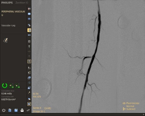 DSA機能で撮影した血管画像