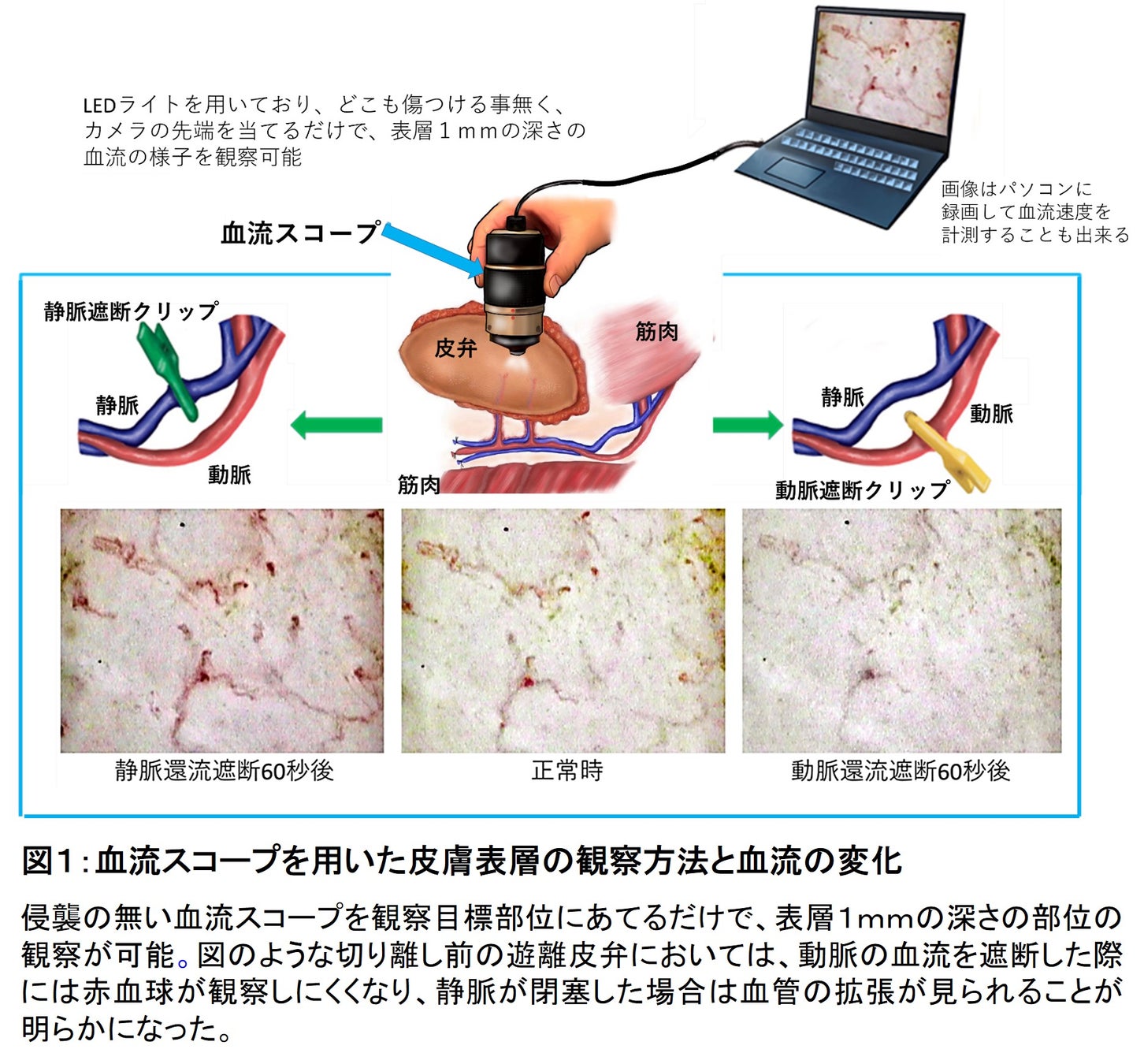 遊離皮弁の皮膚表層深さ1mmの毛細血管循環に対する血流スコープ使用によるリアルタイム評価に成功 | 学校法人 順天堂のプレスリリース