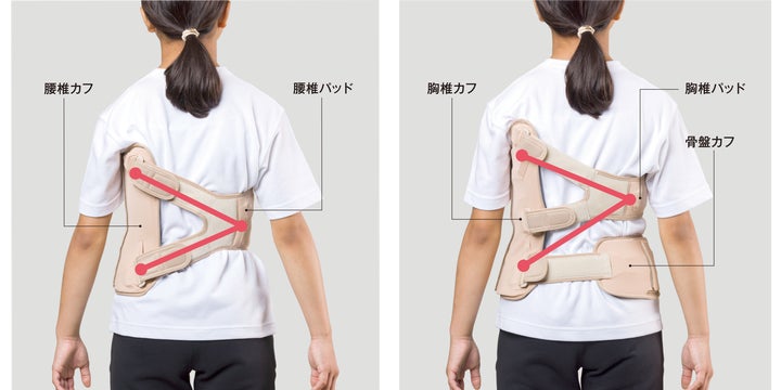 思春期特発性側弯症における装具装着の不快感を軽減 「脊柱の側方への 思春期特発性側弯症における装具装着の不快感を軽減 「脊柱の側方への