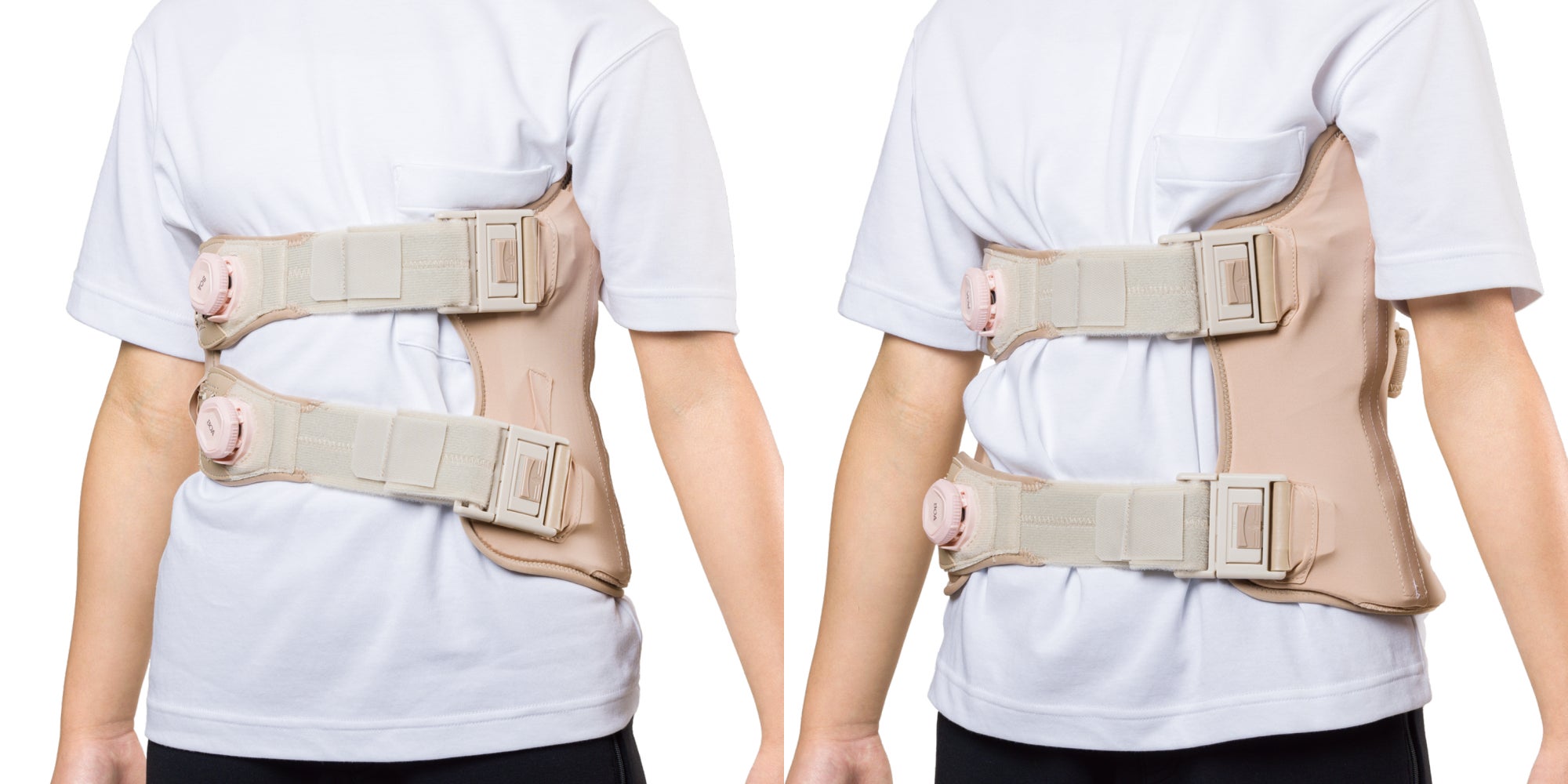 側弯症用コルセット 11-13歳用 思春期特発性側弯症における装具装着の不快感を軽減 「脊柱の側