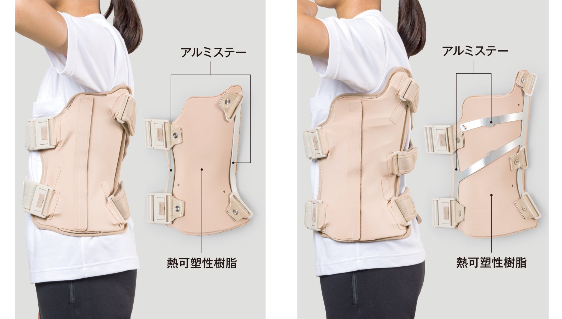 側弯症コルセット 術後 側弯症コルセット 術後