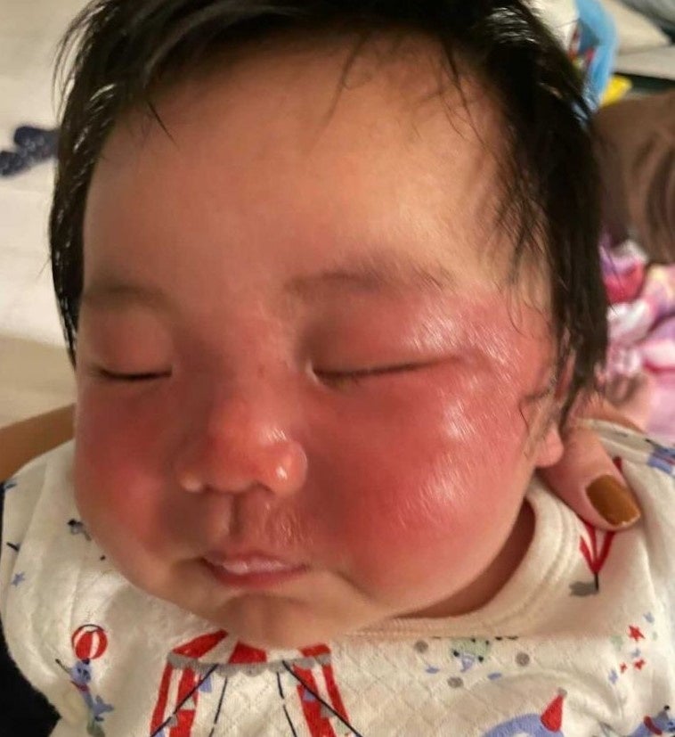 日焼けを起こした赤ちゃんの顔