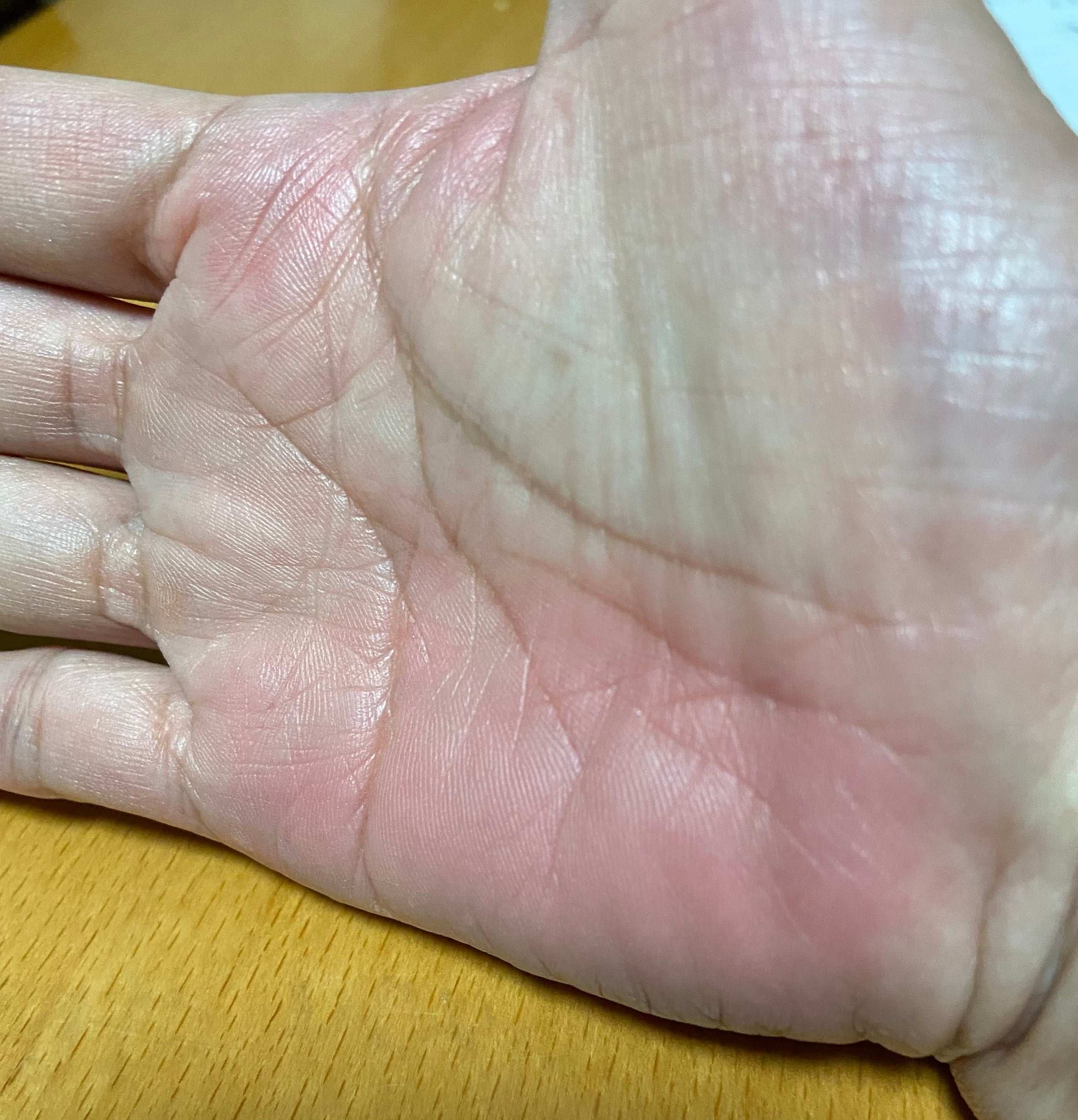 手のひらも日焼けする