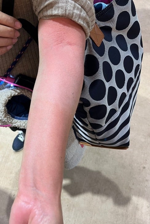 光線過敏症　腕の日焼け