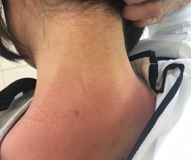 光線過敏症 日焼け 首