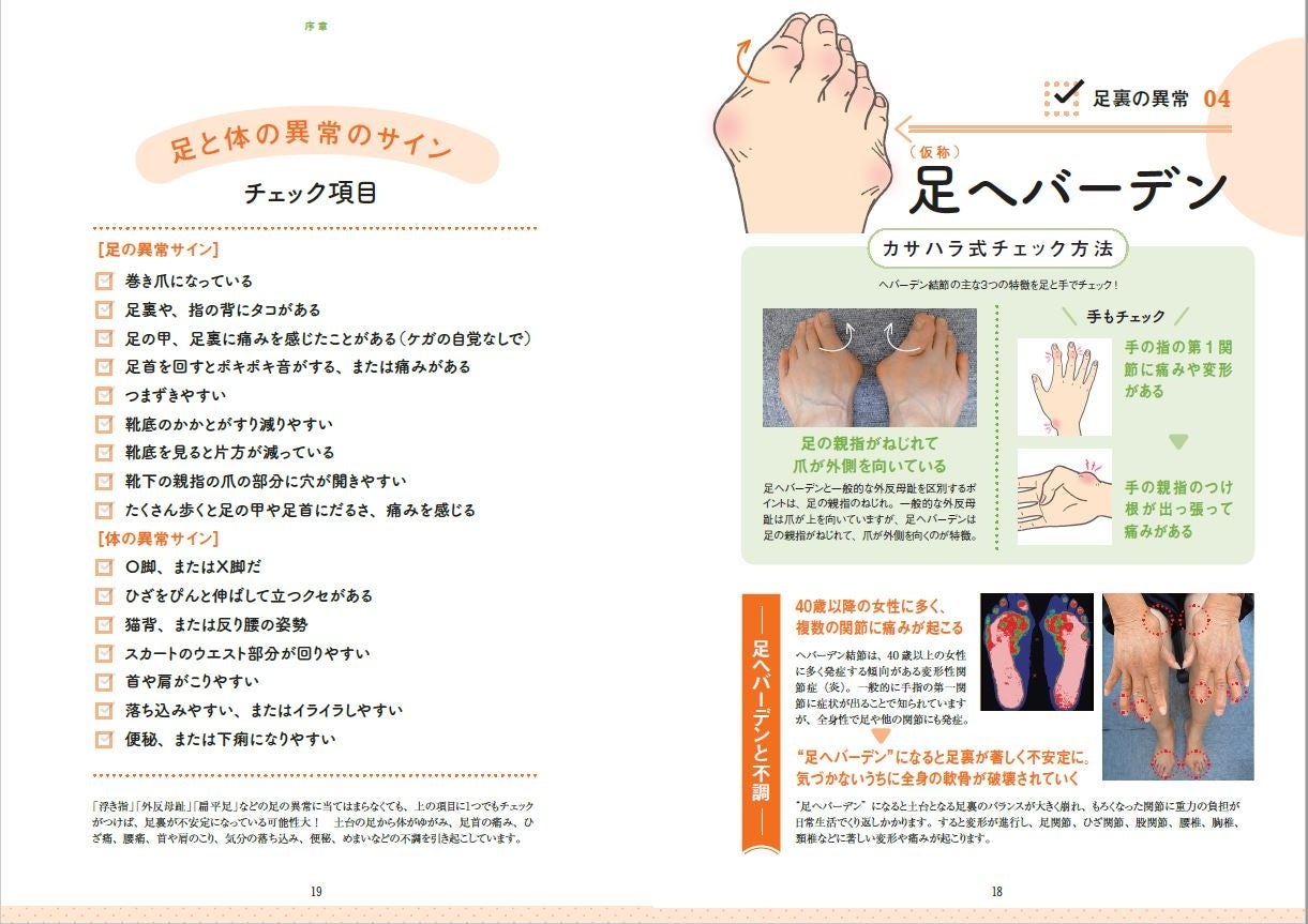 笠原院長が名づけた「足ヘバーデン」。変形が外反母趾と似ているため、これまで見過ごされがちでした。