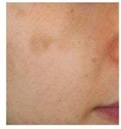 ②赤色ムラを削除した画像