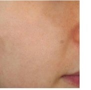 赤色ムラ・茶色ムラをともに削除した画像