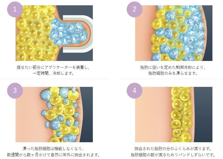 クールスカルプティングエリート効果イメージ